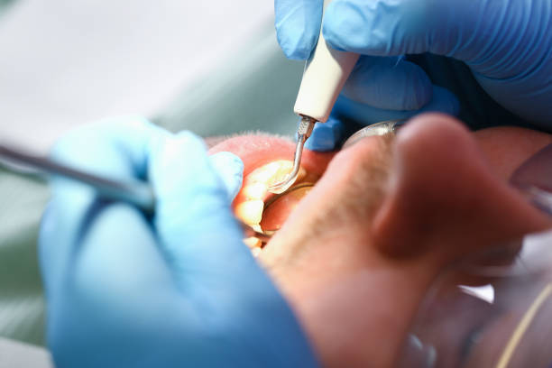 Best Emergency Root Canal Treatment in Chester, MD