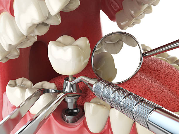 Best Emergency Dental Extractions in Chester, MD